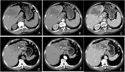 Undifferentiated hepatic carcinoma with osteoclast-like giant cells: A case report and literature review